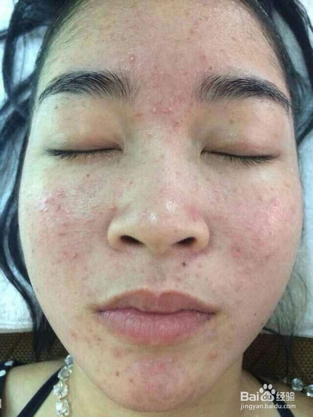 怎样快速修复过敏