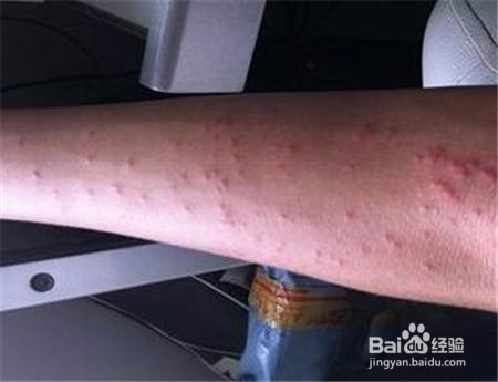 皮肤瘙痒起红疙瘩,怎么办?