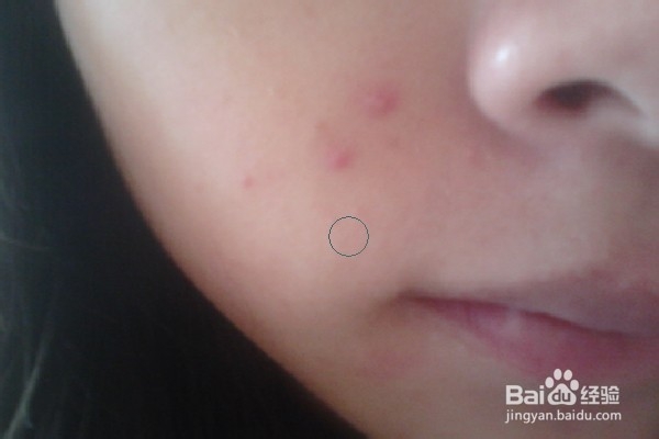 如何用PS去除脸上的痘痘