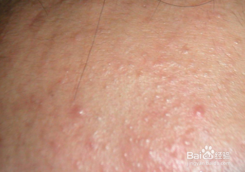 皮肤科医生揭示痤疮的主要原因