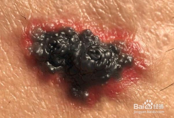 影响男性的最常见类型的癌症