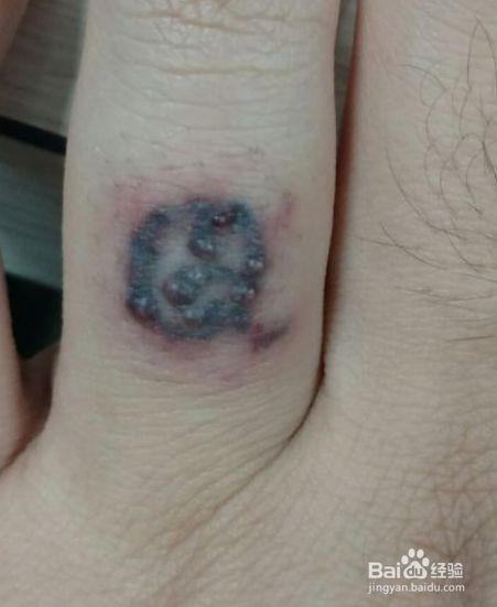 当兵体检手上有纹身怎么办