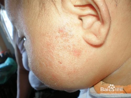 特殊体质的宝宝怎样添加辅食