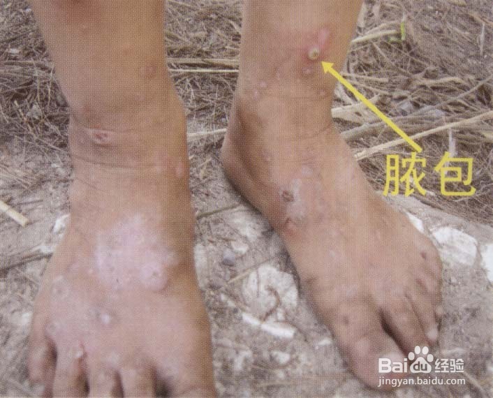 被红火蚁咬到怎么办,高级生物防制员经验告诉你