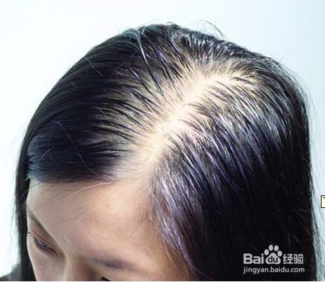 人脱发要怎么办呢