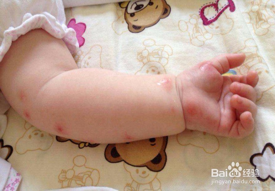 皮肤过敏的诱因是什么?怎么应对?