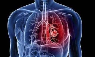 从武汉回来如何预防武汉肺炎