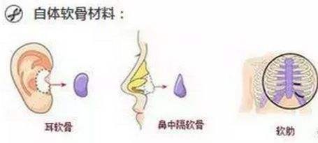 自体软骨隆鼻的效果好吗？