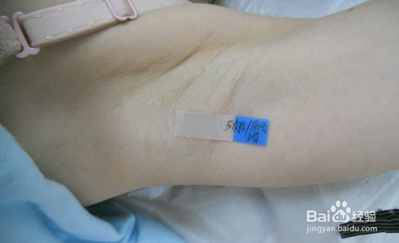 怎样处理腋下脱毛后的毛孔粗大