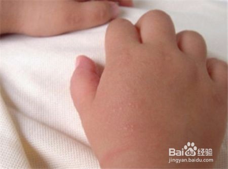 秋冬季用修复凝胶该怎么处理宝宝皮肤干燥问题？