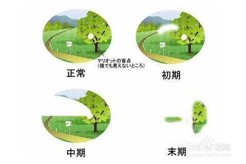 6个表现需要警惕青光眼