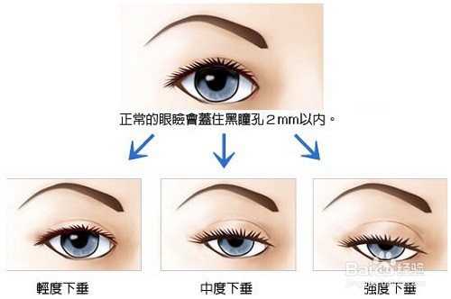 固元提肌汤跟普通中药有什么不一样?