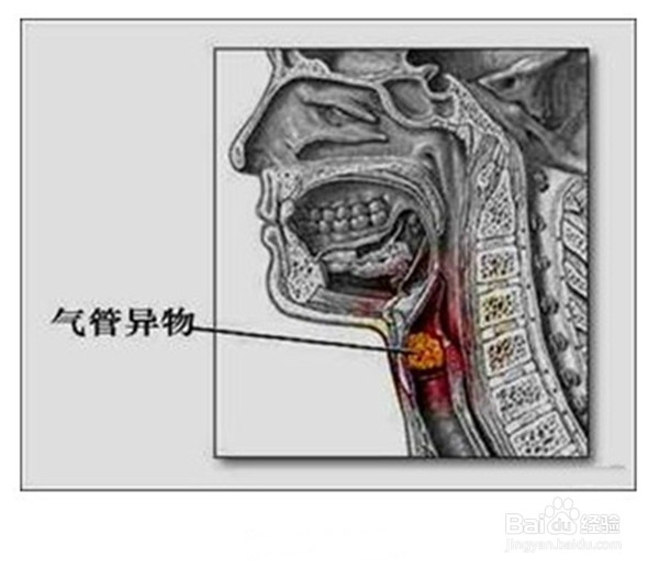 饮食安全（孩子篇5）——食物卡住气管急救法