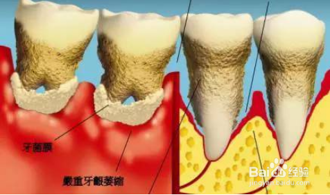 牙龈萎缩的形成及其原因