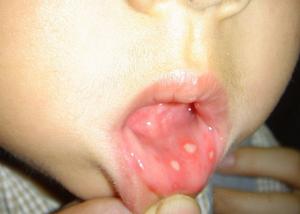 远离口腔溃疡“火”不得