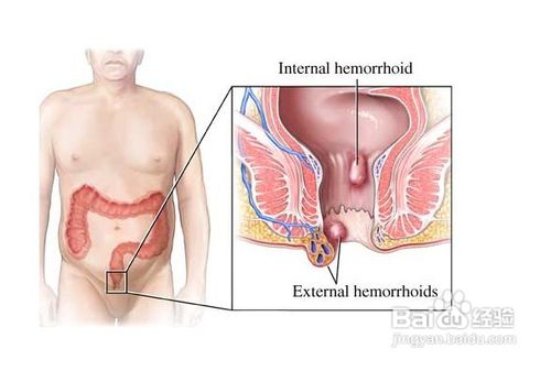 大便出血的原因——六大肛肠疾病