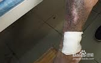 老烂腿治疗最佳方法