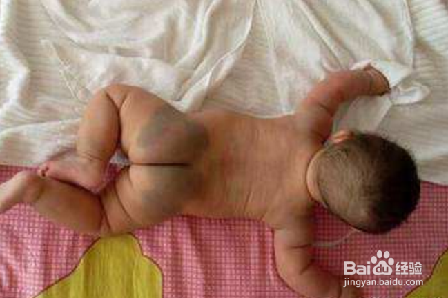 如何对新生宝宝的皮肤问题？