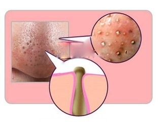 怎么去黑头？我有办法！！