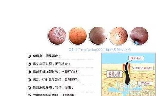 油性皮肤毛孔粗大怎么办