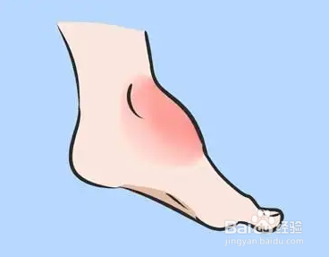 崴过一次脚后容易再次扭伤吗?蚂蚁庄园答案