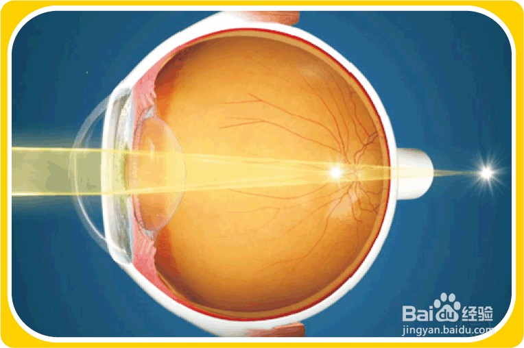 散光能带隐形眼镜吗