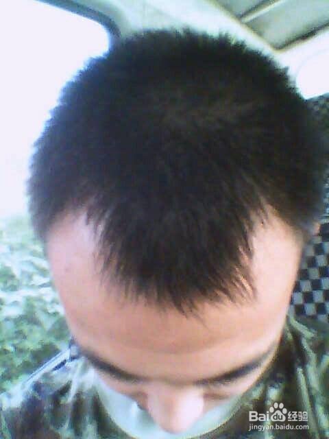 M型 美人尖如何区分