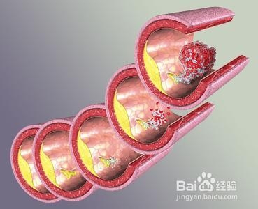 肾病综合征的四个并发症您知道吗
