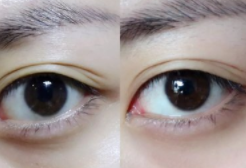 黑眼圈怎么去除