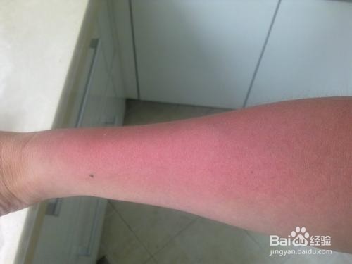 皮肤晒伤后如何治疗？