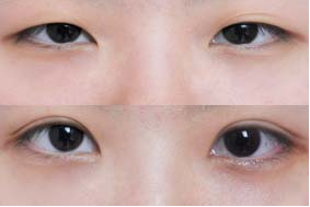 倘若做开眼角手术能做出无痕效果吗
