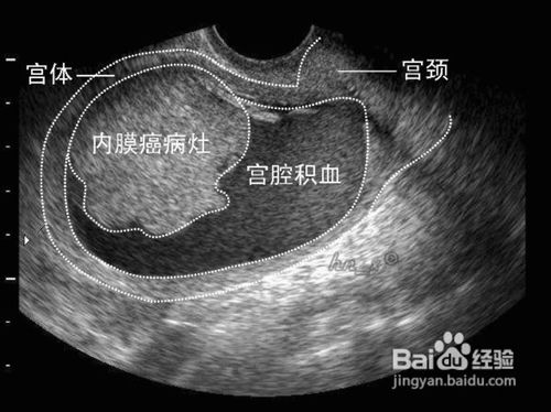 子宫内膜66岁多厚正常图片