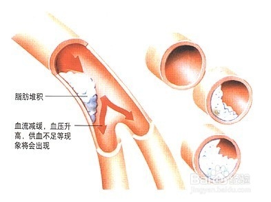 中风偏瘫：[1]中风预防为主，如何预防中风