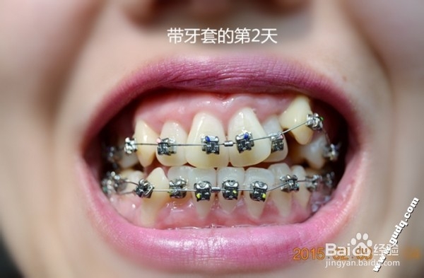 牙齿矫正：[2]带牙套的第二天的感受