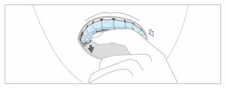 南宁隐形矫治器正确的摘戴方法