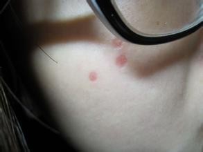 点痣有哪些危害