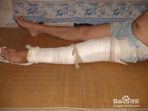 血友病有什么病症，会遗传吗？