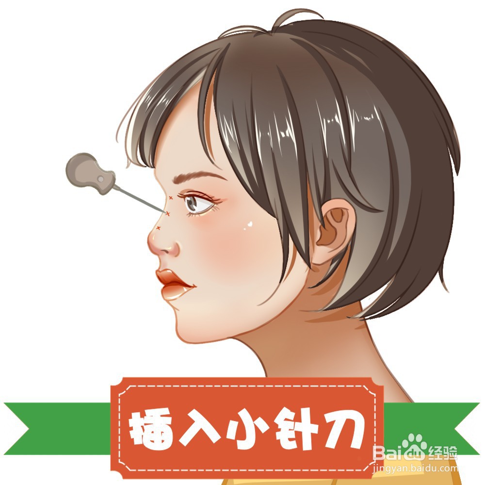 隆鼻手术过程