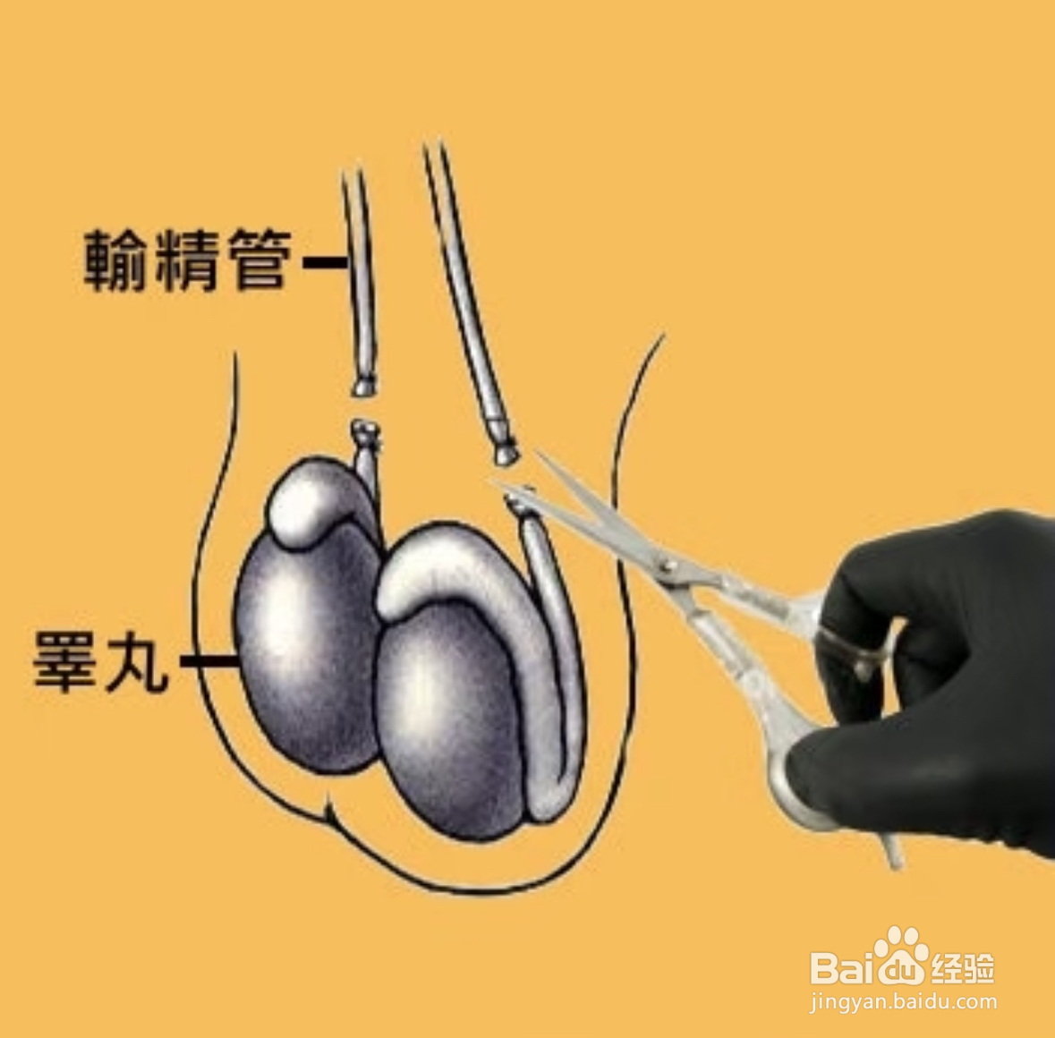 如何选择正确的避孕方式？