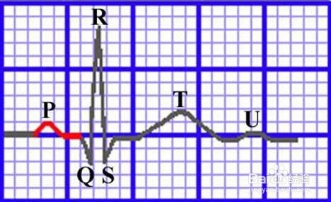 心电图各种波段解析