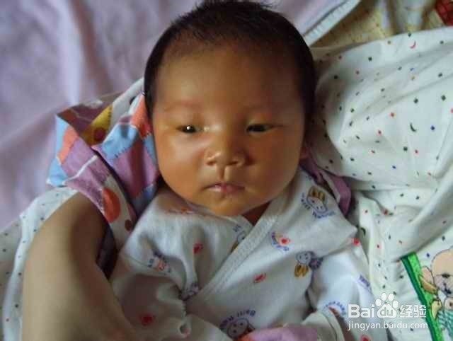 新生儿黄疸如何处理？