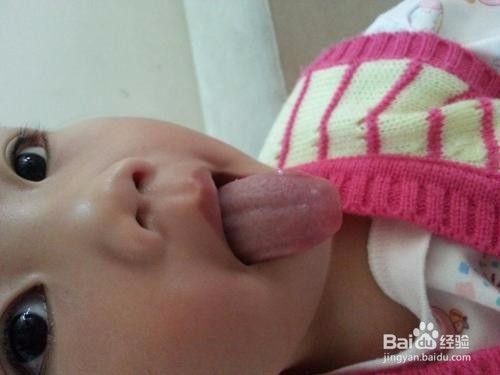 孩子扁桃腺发炎该不该切除