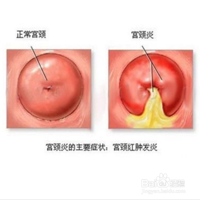 如果女人没了子宫会怎样?