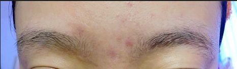 长痘痘的原因及调理方法