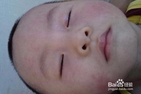 一岁的宝宝小脸痒起包怎么办