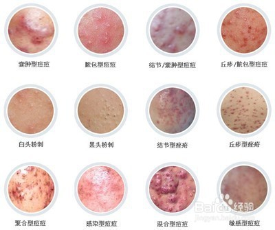 丢掉“痘痘”恢复Baby肌分享经验
