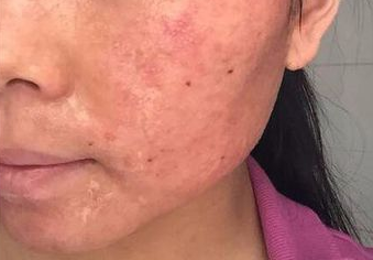 做完超声刀后如何补水？术后要敷一个月面膜？