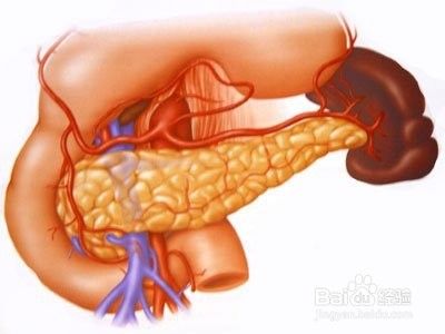 怎麼預防急性胰腺炎