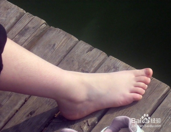 脚部脱皮干裂是什么原因?秋冬季该怎么预防?