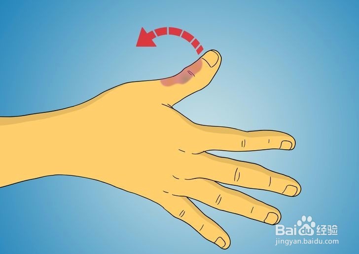 如何诊断拇指是否骨折?